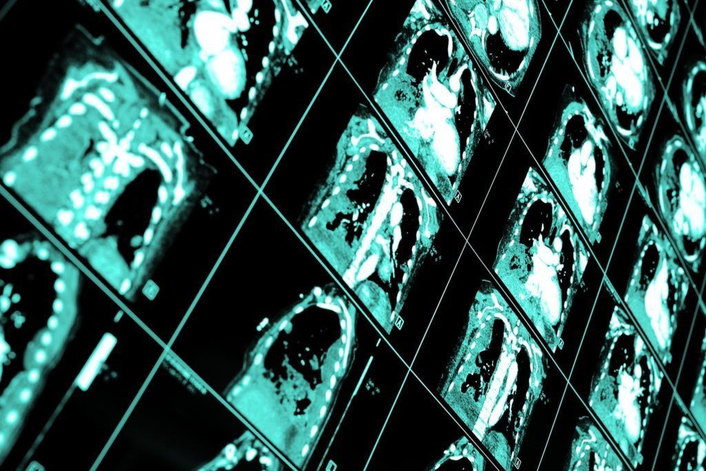 Strisce di pellicola radiografica turchese disposte in diagonale, che mostrano molteplici scansioni mediche nere