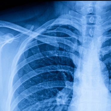 Radiografia del torace che mostra costole, clavicola e polmoni in tonalità blu.