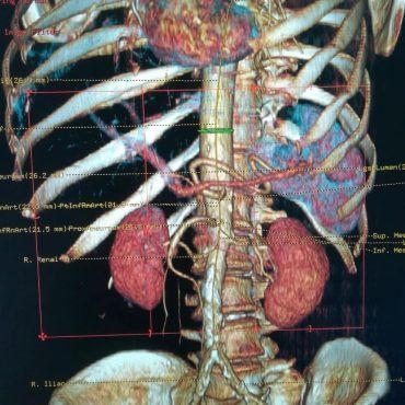 Tomografia computerizzata 3D che mostra reni, colonna vertebrale, costole e vasi sanguigni addominali con sovrapposizioni di misurazione.