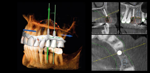 Une image générée par ordinateur des dents et des gencives d'une personne.