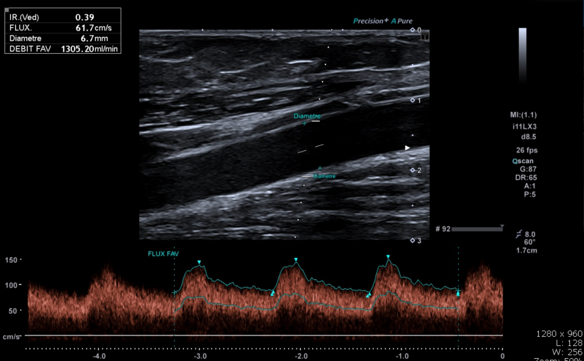 Doppler de fistule d'hémodialyse