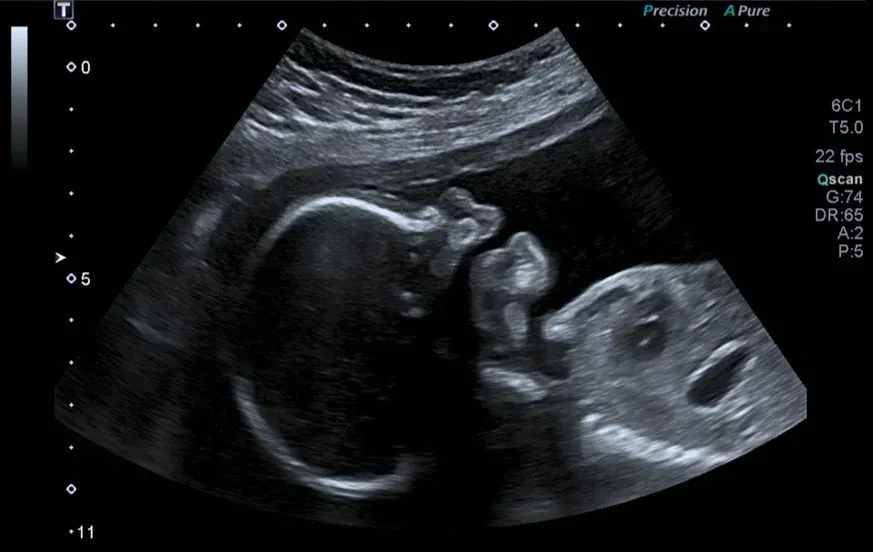 Une échographie en noir et blanc d'un bébé dans l'utérus