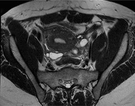 IRM endométriose