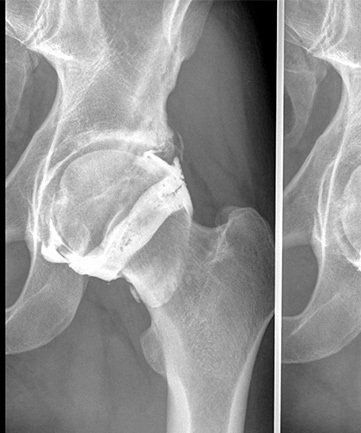 Une radiographie en noir et blanc d'une articulation de la hanche.