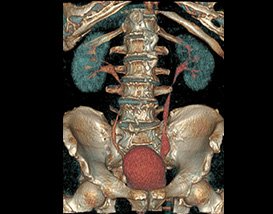 Un scanner 3D des reins et de la vessie d'une personne.