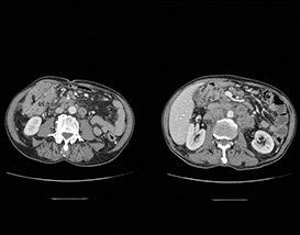 Un scanner noir et blanc de l'abdomen et du foie d'une personne.