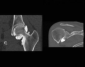 Un scanner d'une articulation de la hanche et un scanner d'une articulation de l'épaule.
