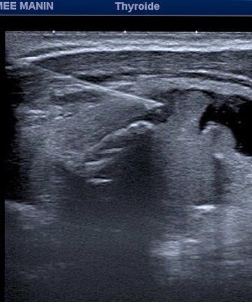 Une image échographique en noir et blanc d'une glande thyroïde.