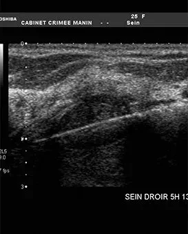 Une image échographique en noir et blanc d'un muscle.