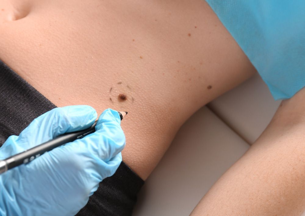 A Doctor is Drawing a Spot on a Woman's Skin — Northern Beaches GP Superclinic in Jensen, QLD