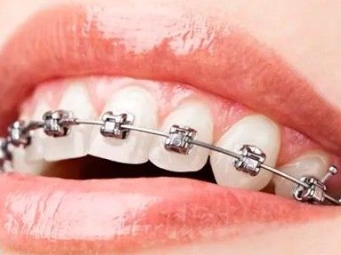 Primer plano de una boca con brackets metálicos en los dientes superiores. Se aprecian labios rosados ​​y dientes blancos.