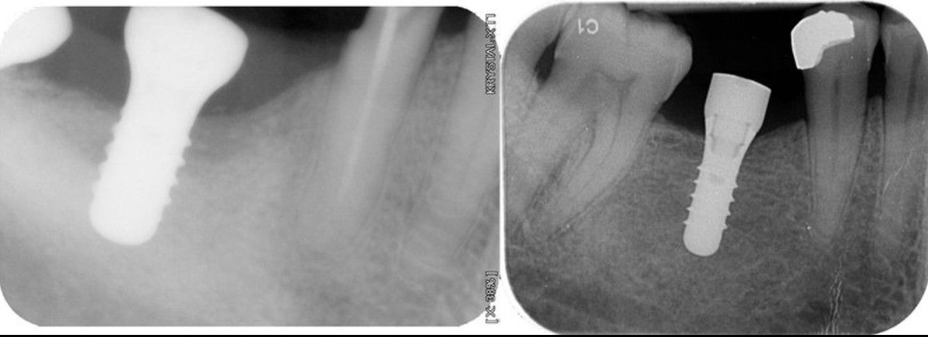 Radiografías dentales que muestran implantes dentales. Un implante a la izquierda, otro a la derecha con un diente cercano.