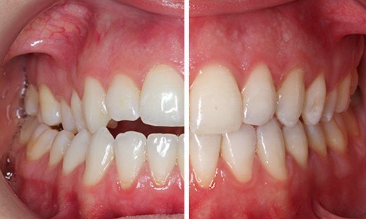 Comparación de dientes antes y después del tratamiento de ortodoncia.