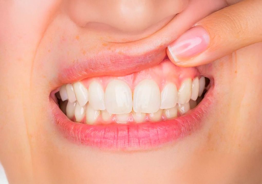 Studio Dentistico Murruni, Giussano, parodontologia