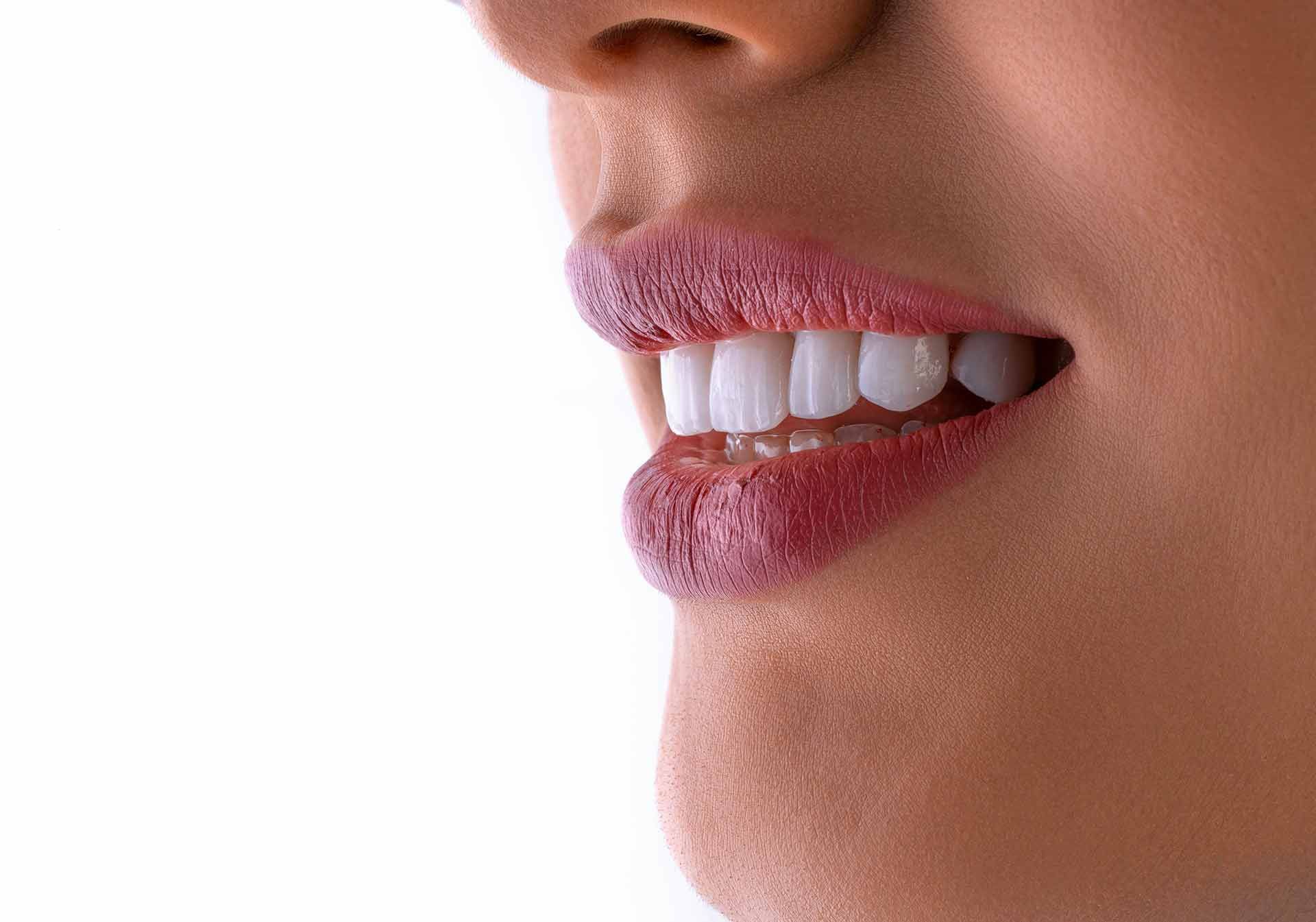 sbiancamento dentale