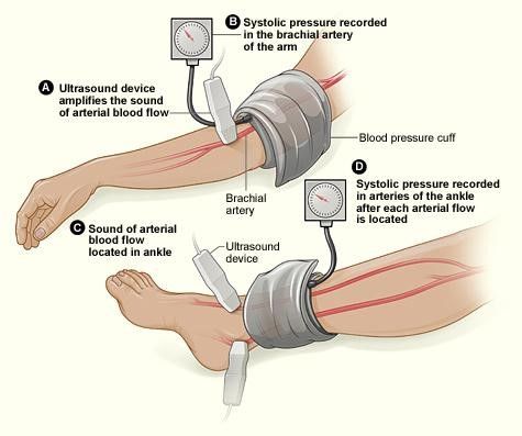 Ankle Brachial Index Ankle Brachial Index