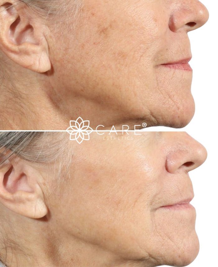 Micronnedling with PRF Before and After