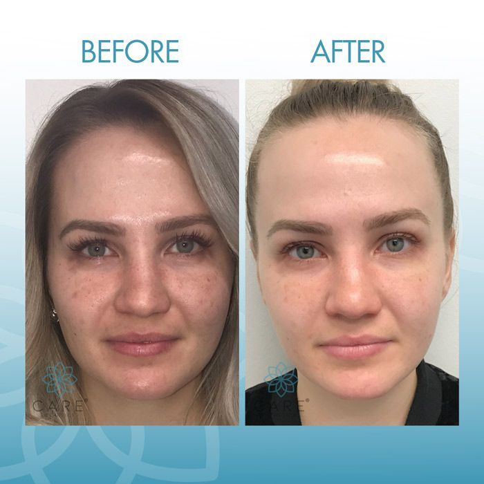 Bio-Lift Before and After