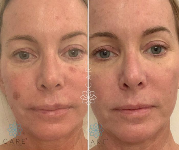 Sun Spot Removal