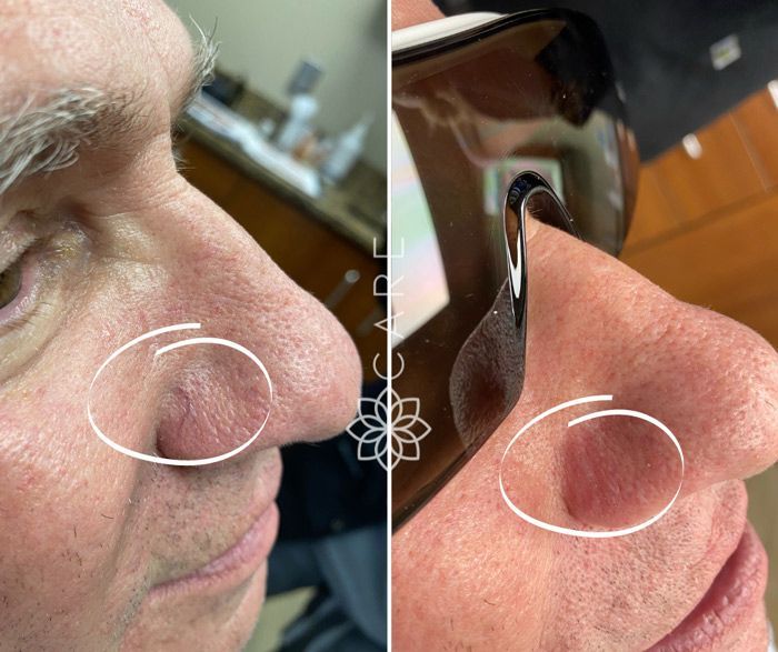 Laser Scar Removal