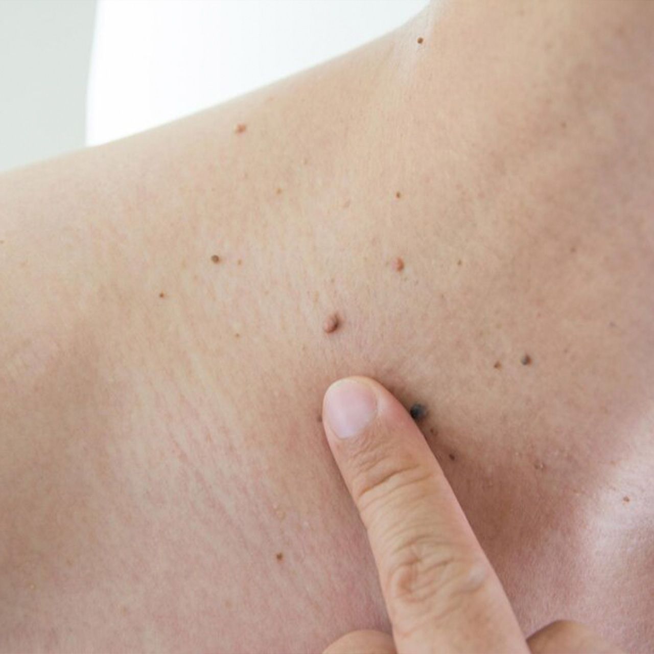 A person is pointing at a mole spot on their chest.