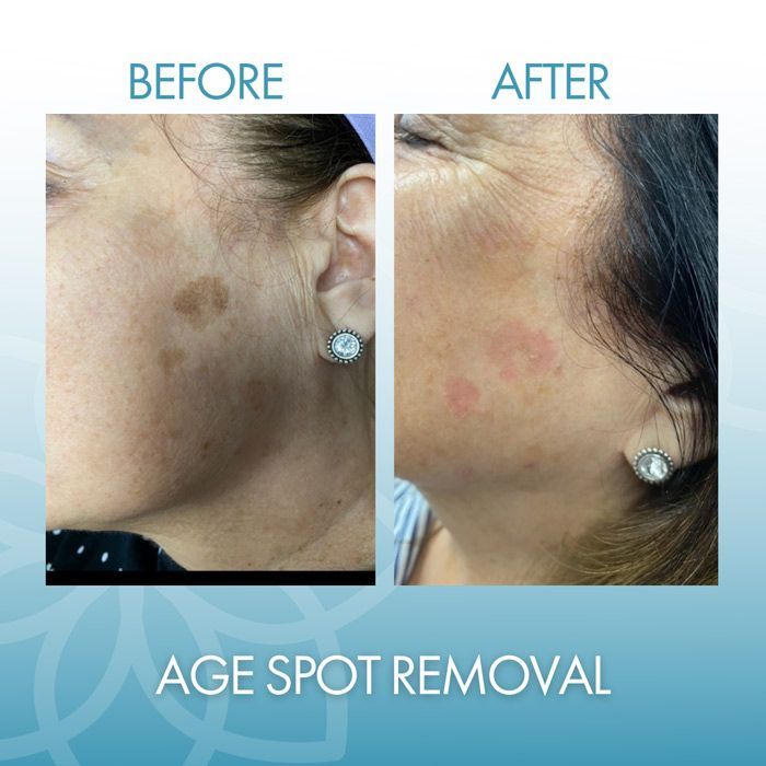 Age Spot Removal-Facial Lasering
