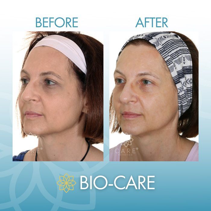 Facial Lasering Before and After Results