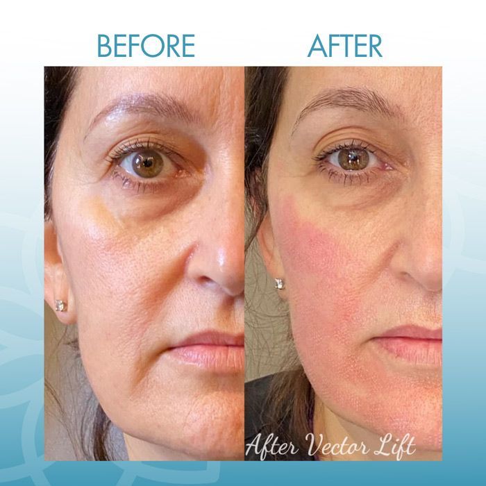 Bio-Lift Before and After