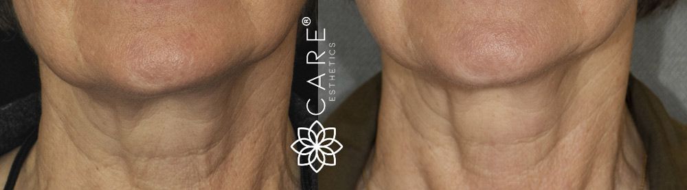 Sagging Skin Treatment-PDO Threads