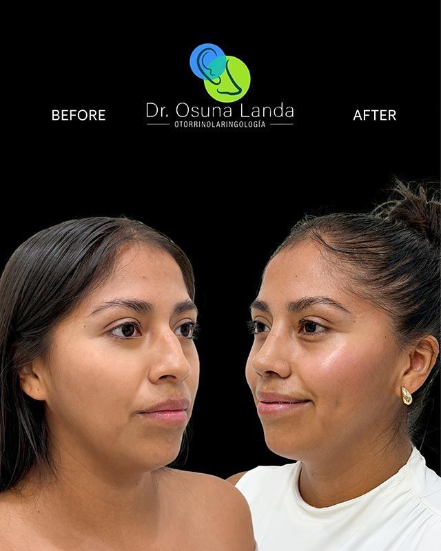 Rinoplastia funcional en La Paz