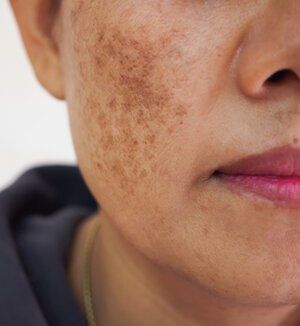 Pigmentation — St. Marys, GA — Coastal Wellness Family Medicine