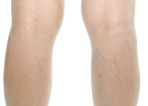 Spider Veins — St. Marys, GA — Coastal Wellness Family Medicine