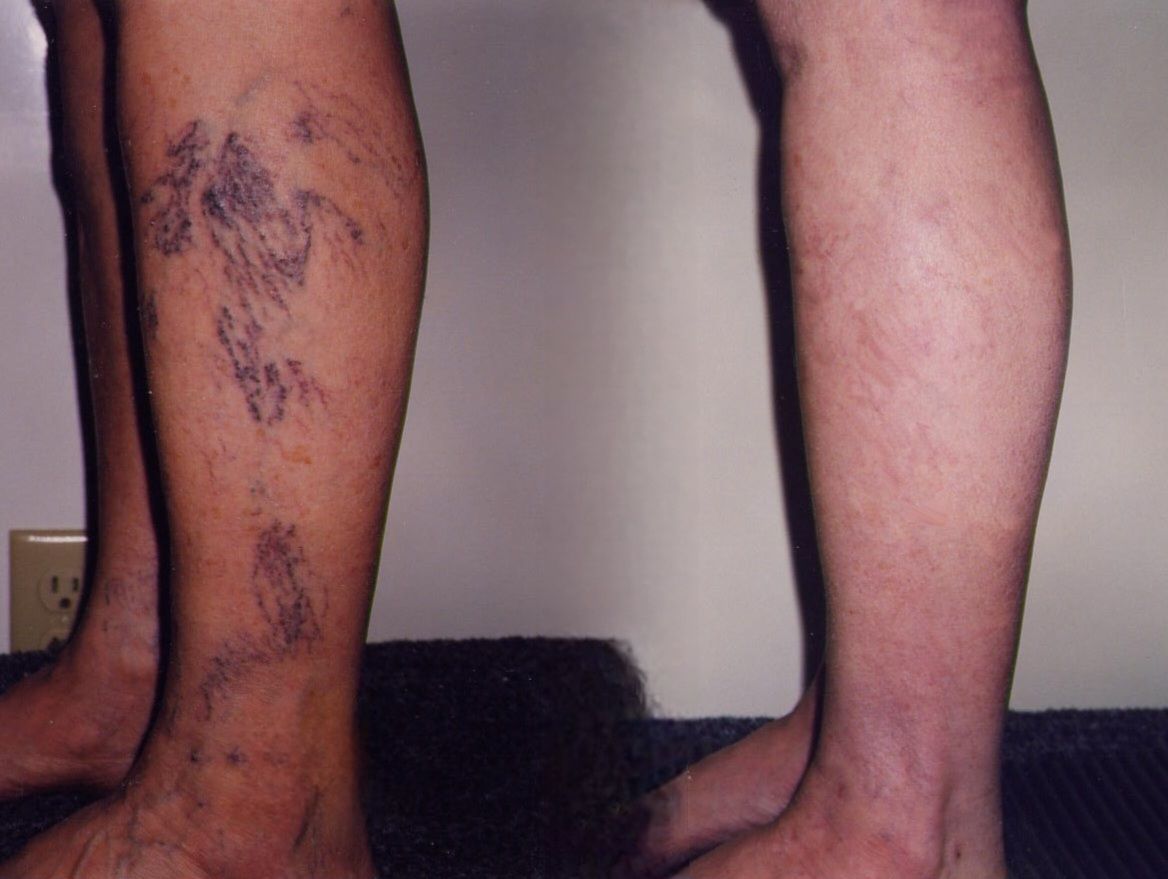 Sclerotherapy, Anti-Aging Treatments, Pigmentation,