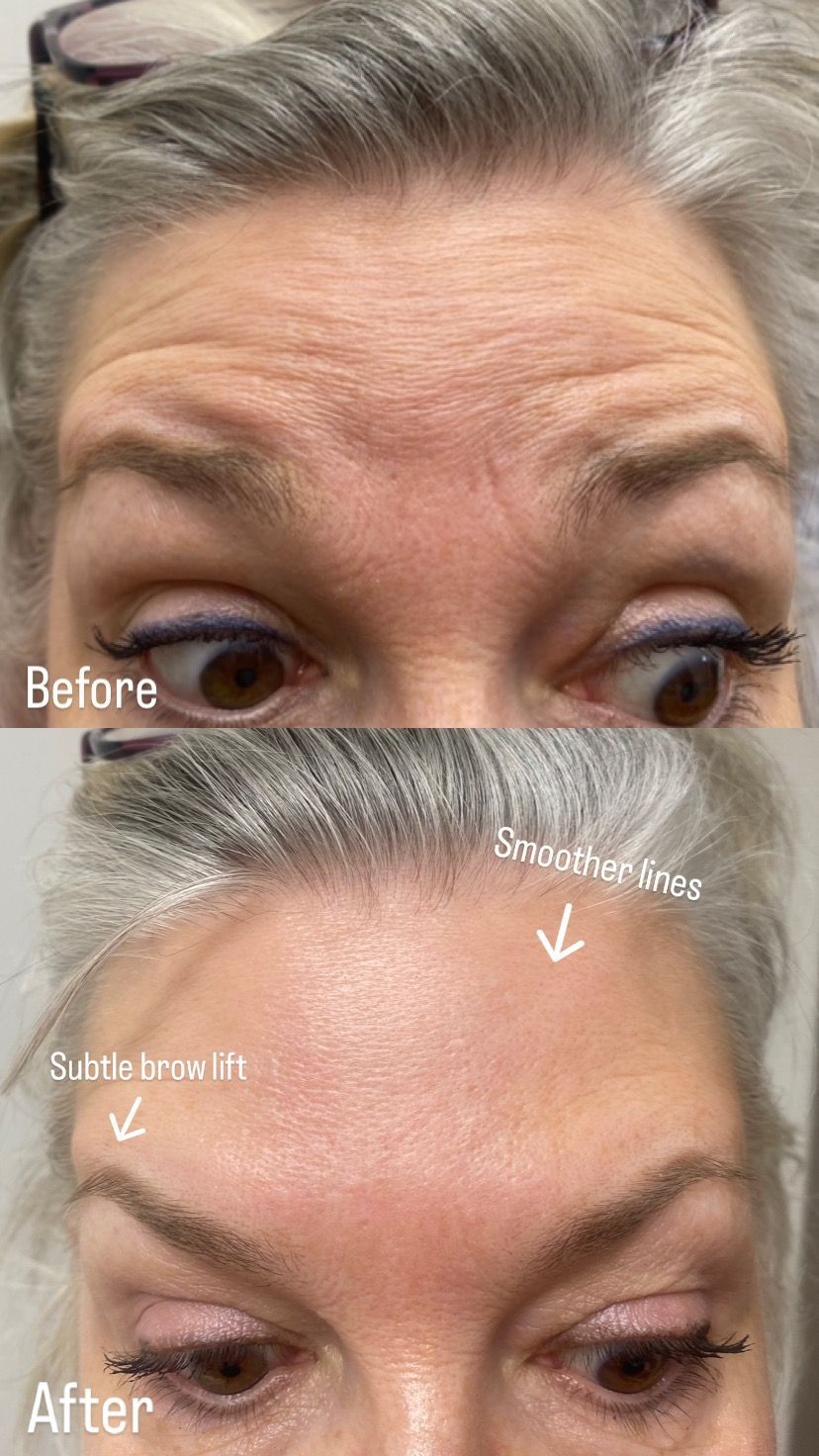 Cosmetic Skin , Botox, Fillers, Anti-Aging Treatments