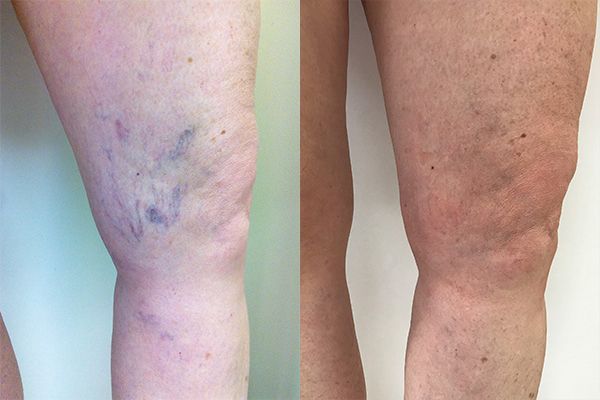 cosmetic Dermatology Botox, Fillers, Sclerotherapy,