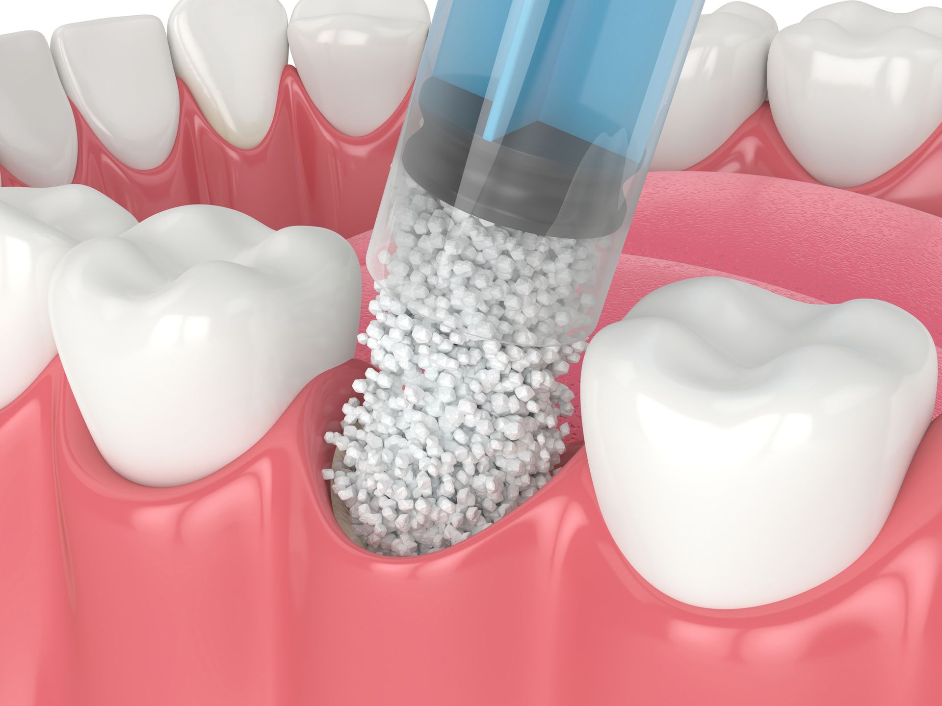 A 3d rendering of a dental bone grafting.