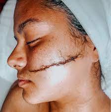 profile view of client showing partial completed dermaplane with bottom half of face up to cheek is bare.
