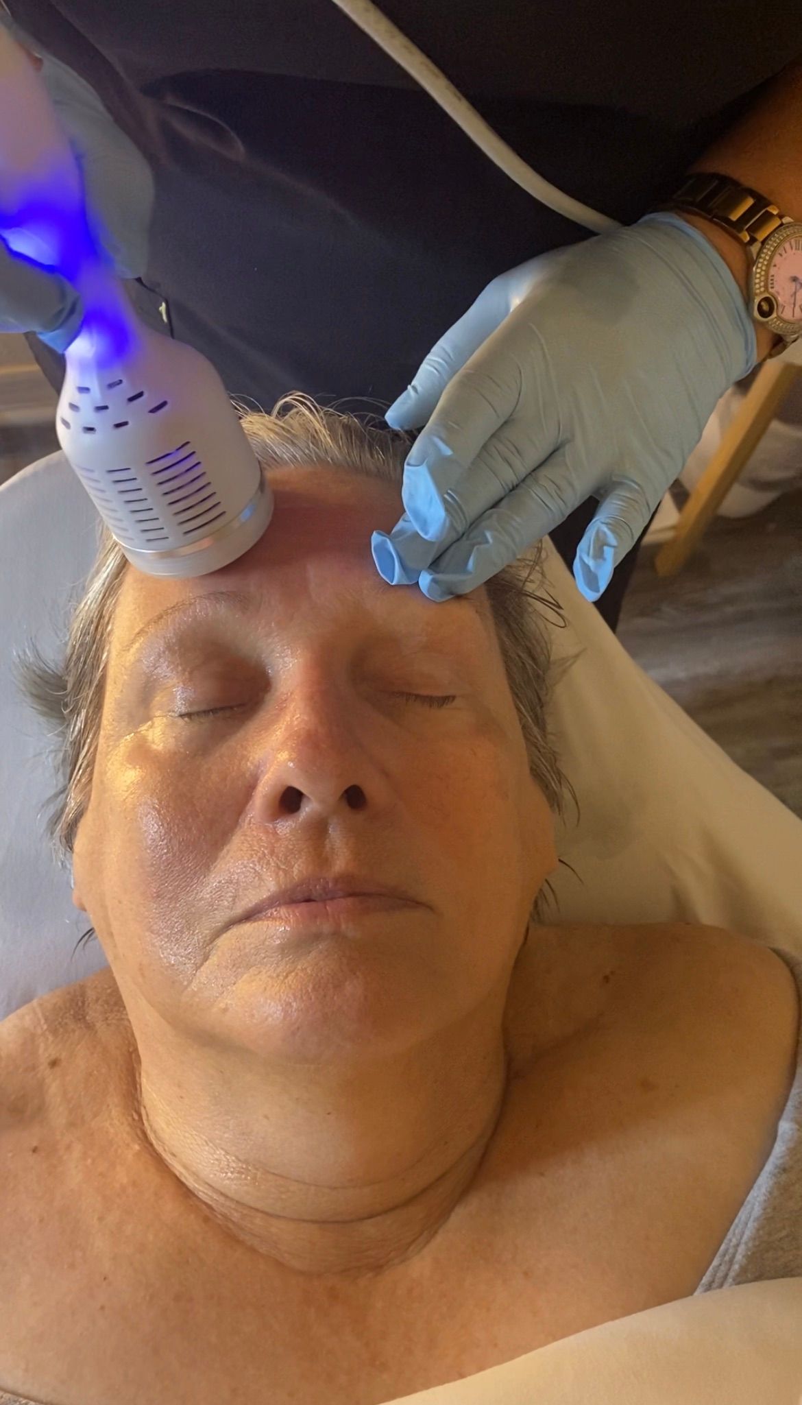 working on forehead during rosacea facial treatment