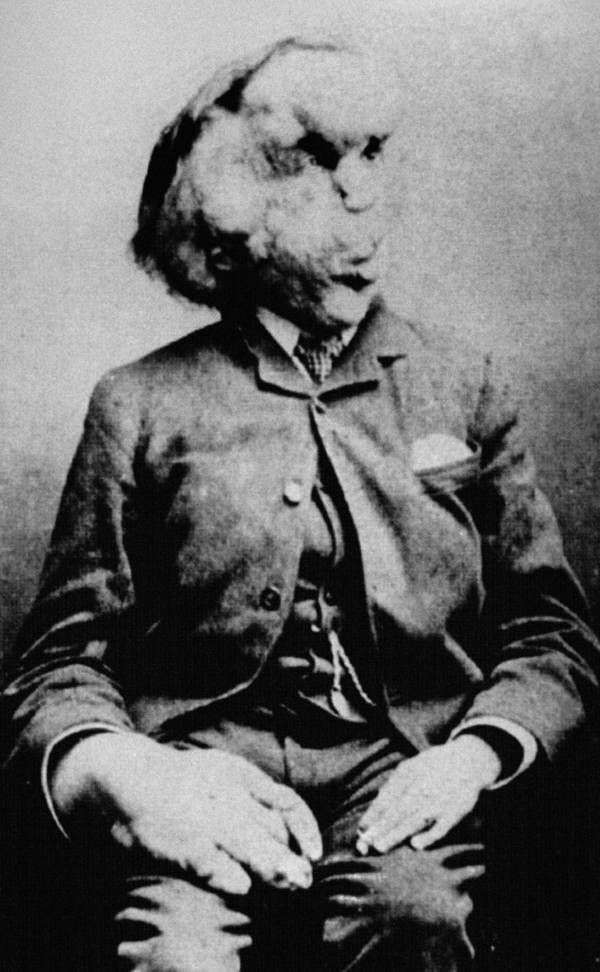 Man with severe facial and bodily deformities, wearing a suit, seated.