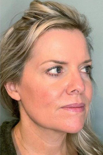after microneedling service