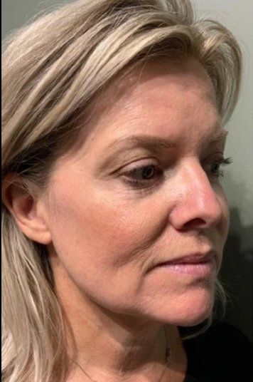 before microneedling service