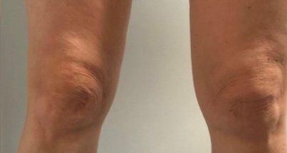 A close up of a person 's knee with a white background.