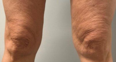 A close up of a person 's knee with wrinkles.
