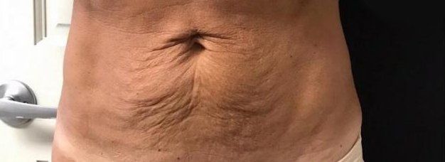 before stomach sculpting