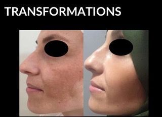 Side-by-side view of a person’s face before and after a procedure, showing skin transformation.