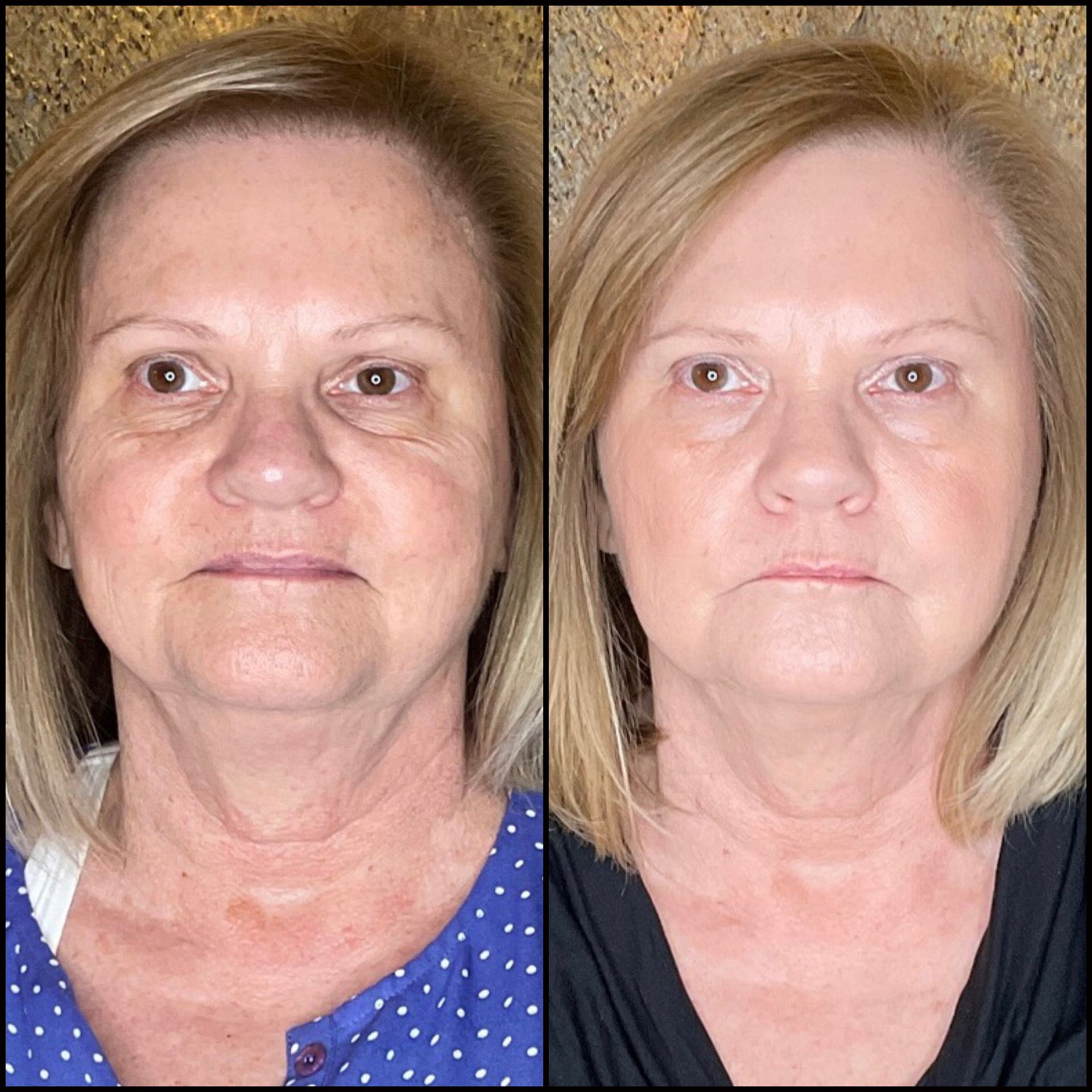 Side-by-side photos of a woman's face, showing her appearance before and after a procedure, with smoother skin.