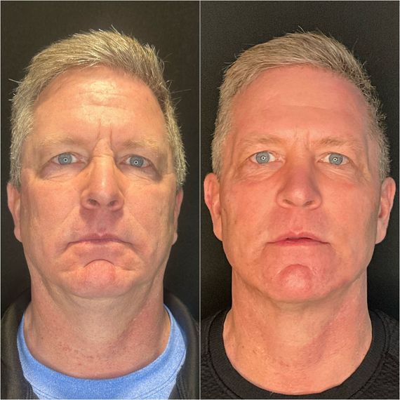 Side-by-side portrait of the same man under different lighting, neutral expression, dark background