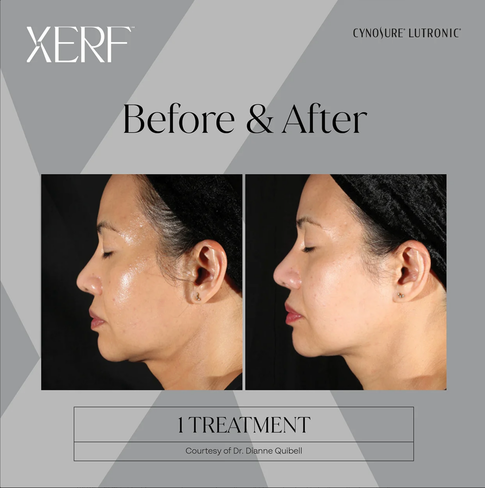Before and after side-profile facial treatment comparison on a gray promotional poster.