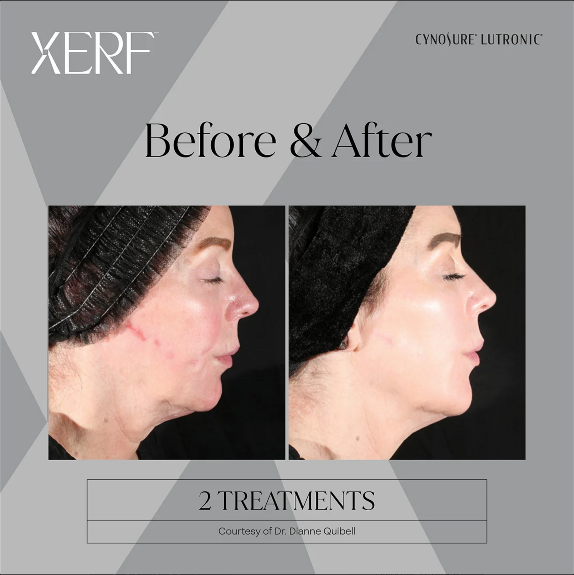 Before and after profile photos showing facial skin improvement, labeled “2 Treatments.”