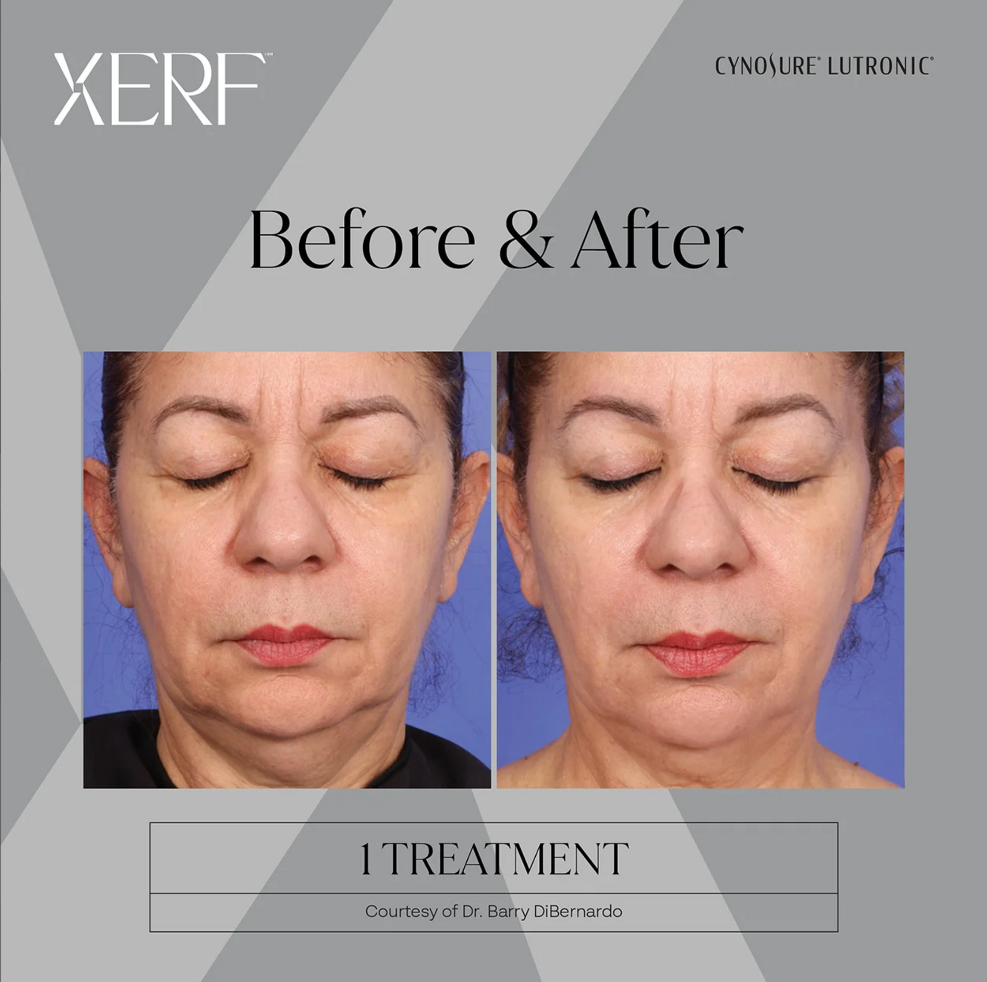 Before and after facial treatment comparison showing reduced wrinkles and fuller lips